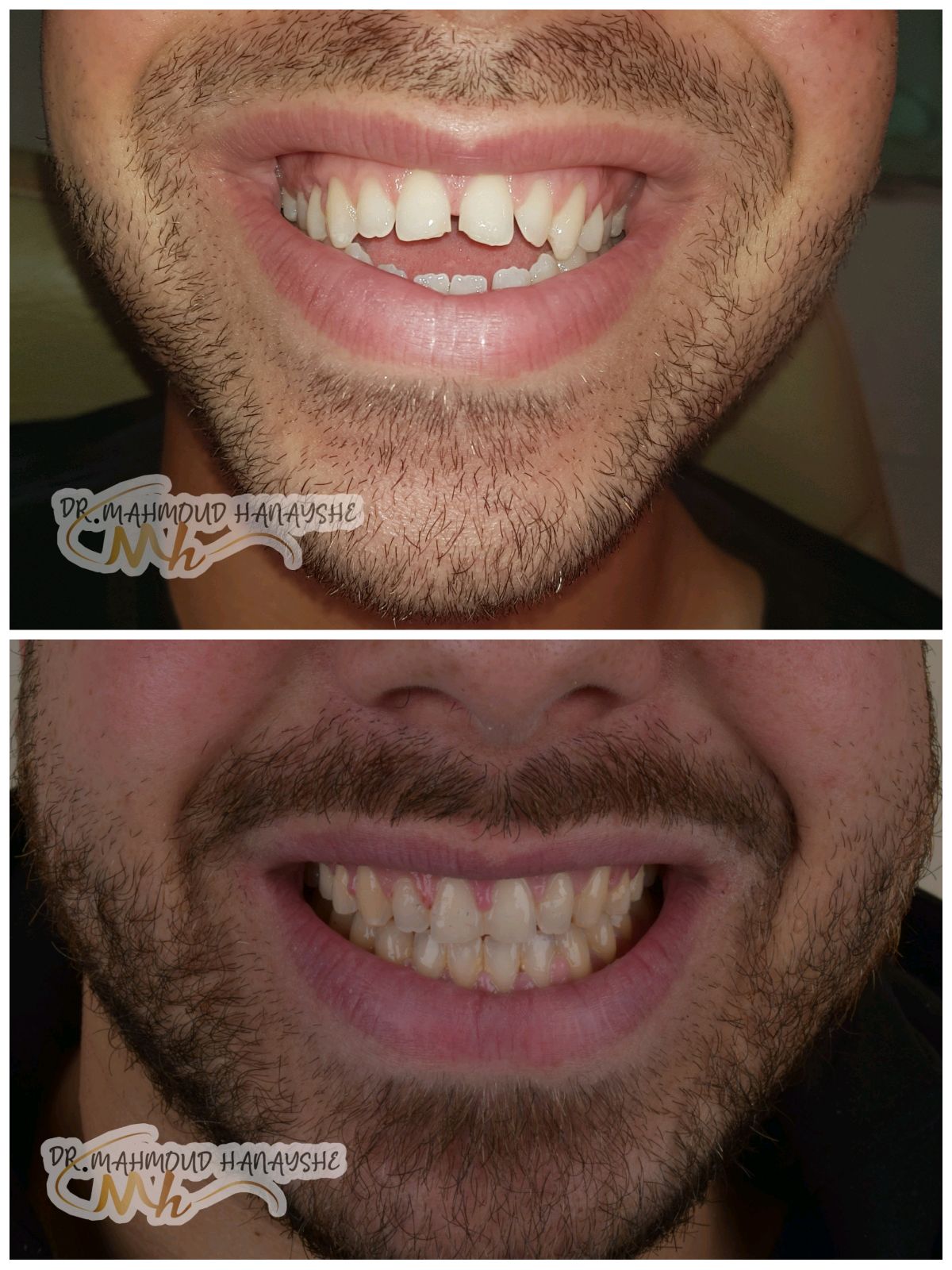 المركز الاستشاري لتقويم وتجميل الاسنان (د. محمود حنايشه) - صورة 5
