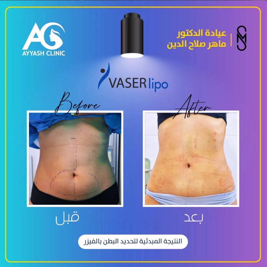 د. ماهر صلاح الدين لجراحة السمنة وشفط الدهون - صورة 4