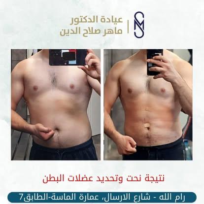 د. ماهر صلاح الدين لجراحة السمنة وشفط الدهون - صورة 6