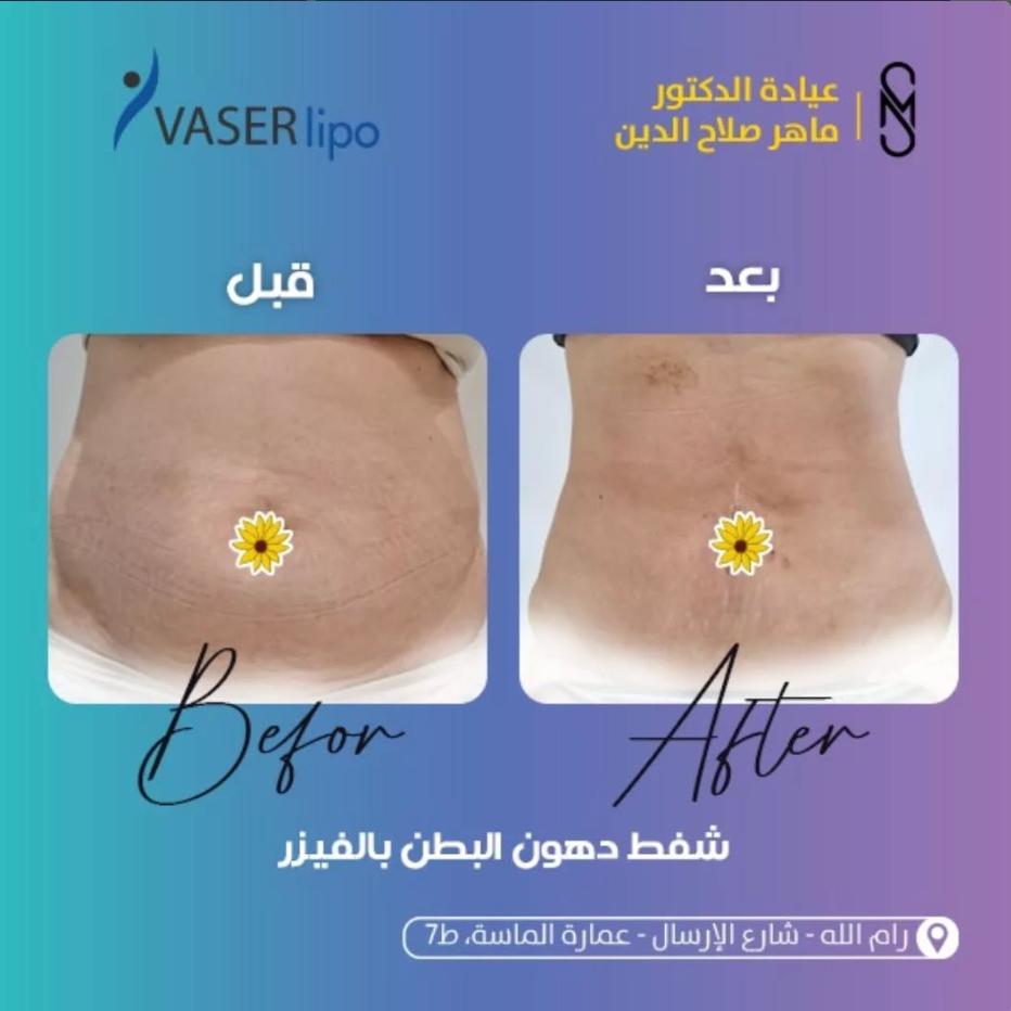 د. ماهر صلاح الدين لجراحة السمنة وشفط الدهون - صورة 3
