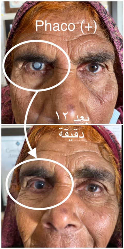 مركز الليزك وجراحة القرنية المخروطية - O CliniC - صورة 7